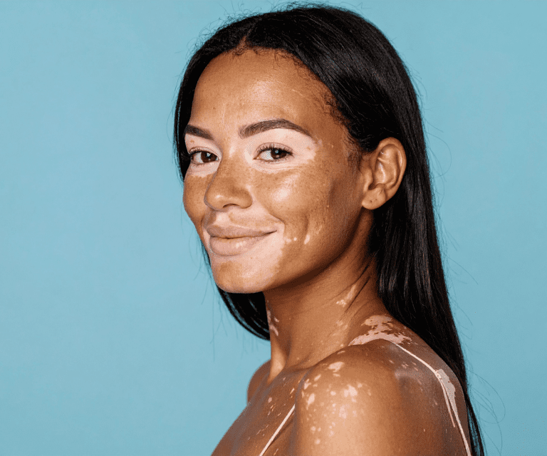 Vitiligo