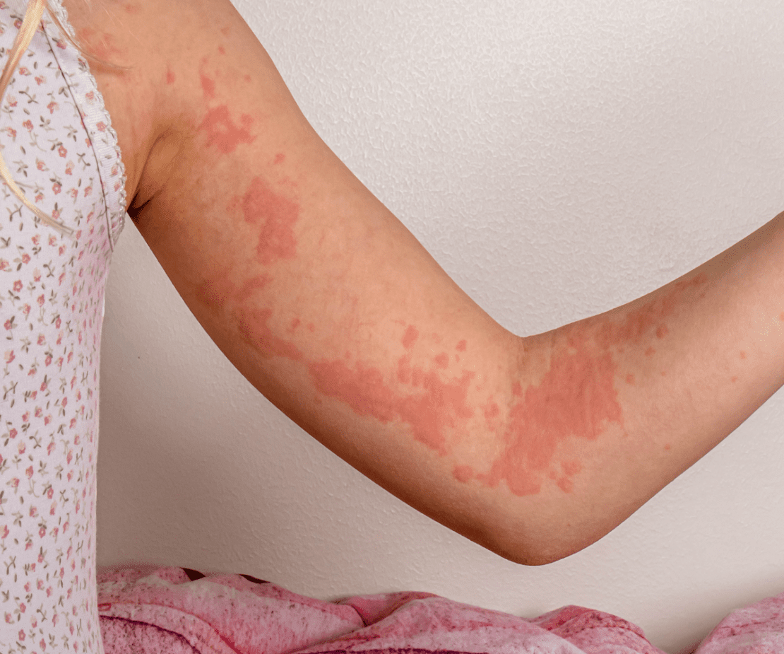 Urticária