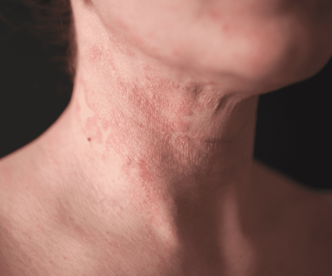 Dermatite seborreica