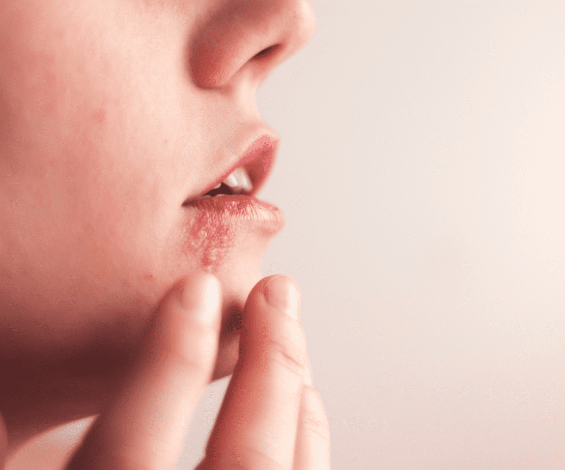 Herpes simples e zoster