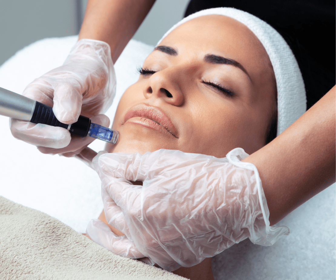 Microagulhamento Facial