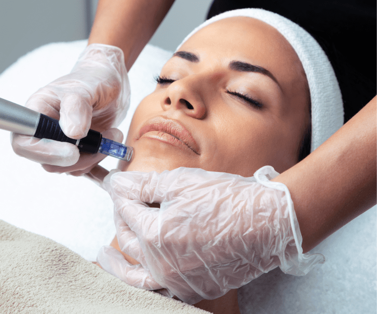 Microagulhamento Facial
