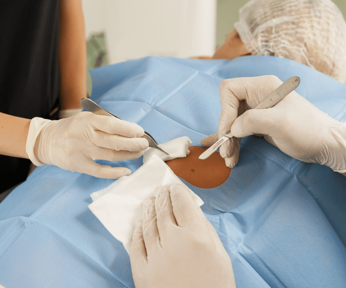 Pequenas Cirurgias Dermatológicas