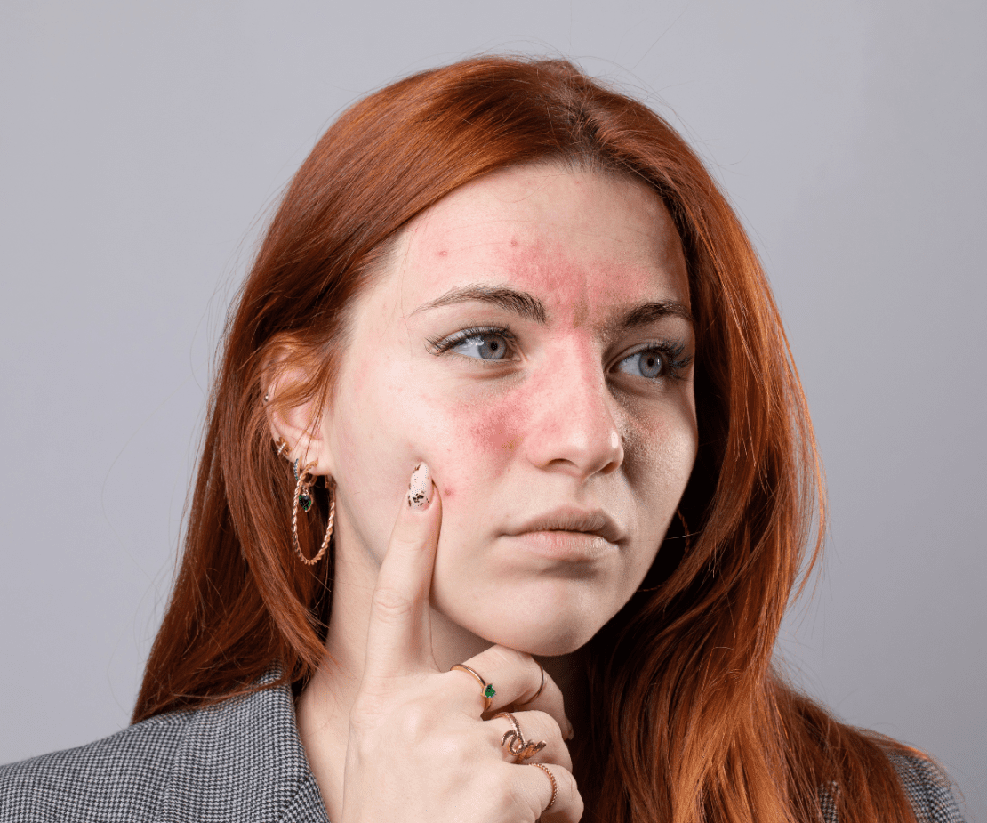 Rosácea