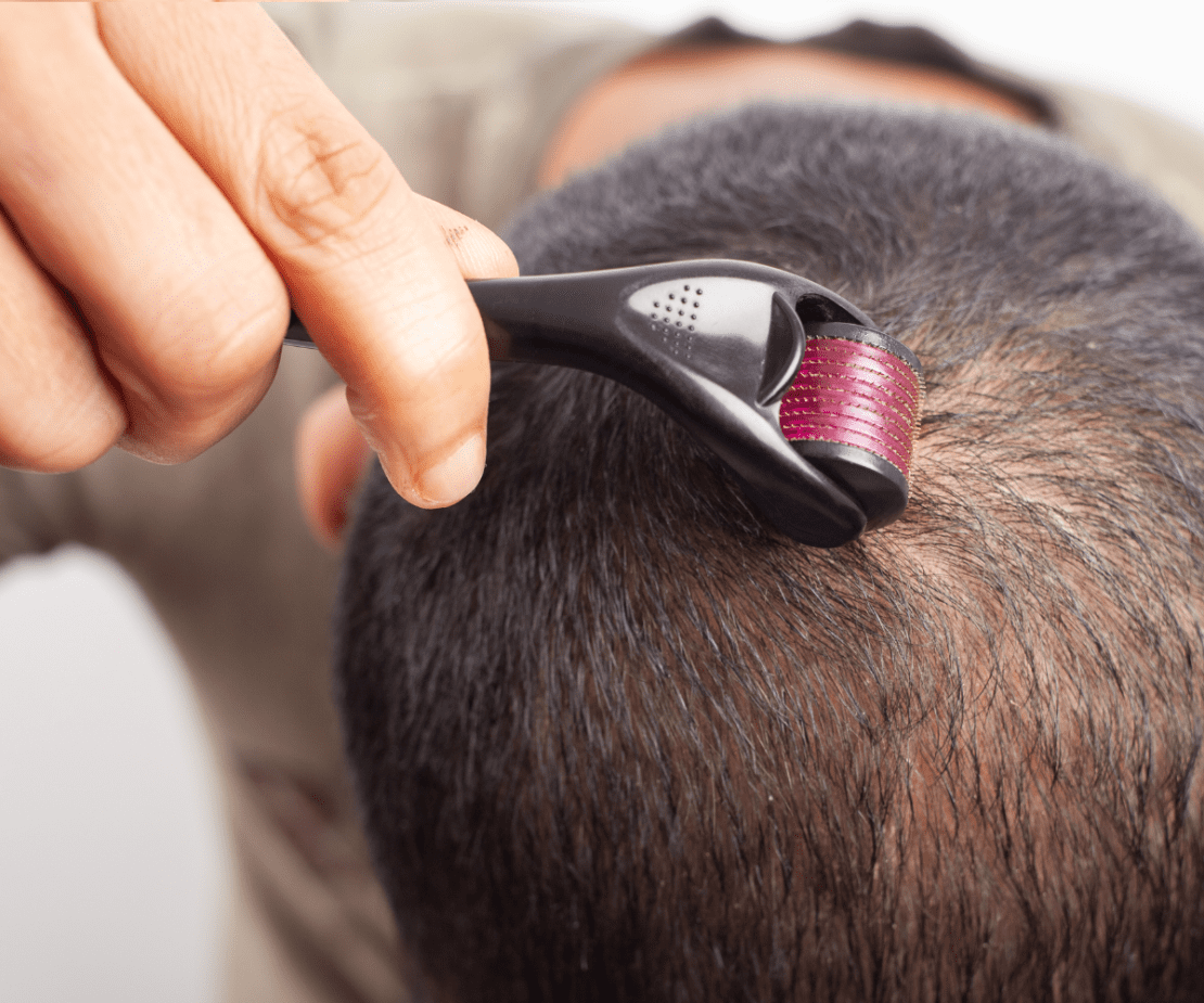 microagulhamento capilar