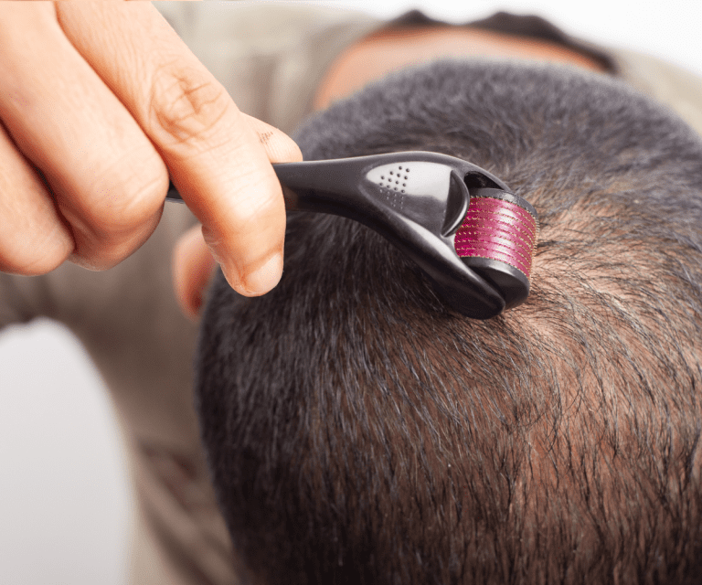 microagulhamento capilar